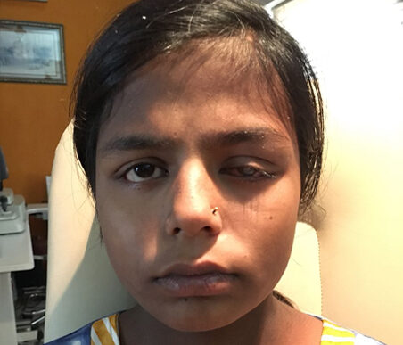 A patient treated under Mission Gift of Sight