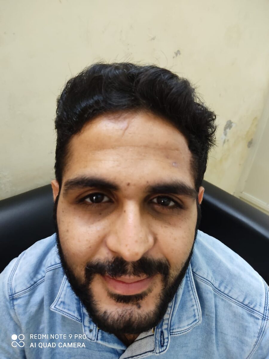 A patient treated under Mission Gift of Sight